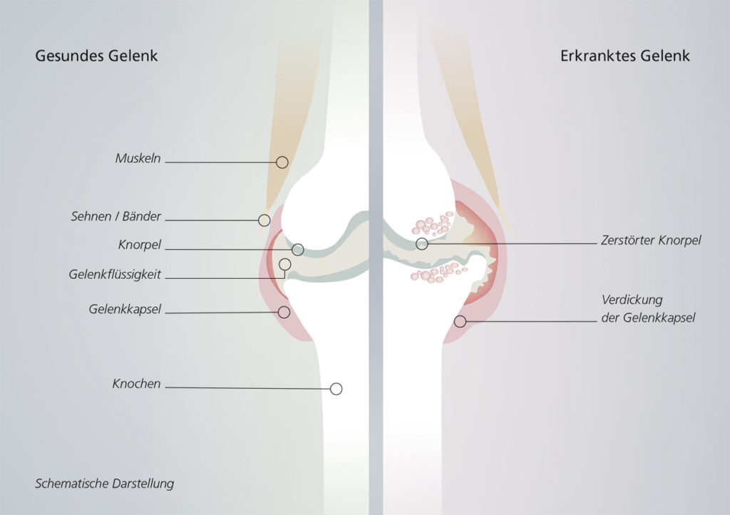 Schematische Darstellung von einem Gesunden und erkranktem Gelenk